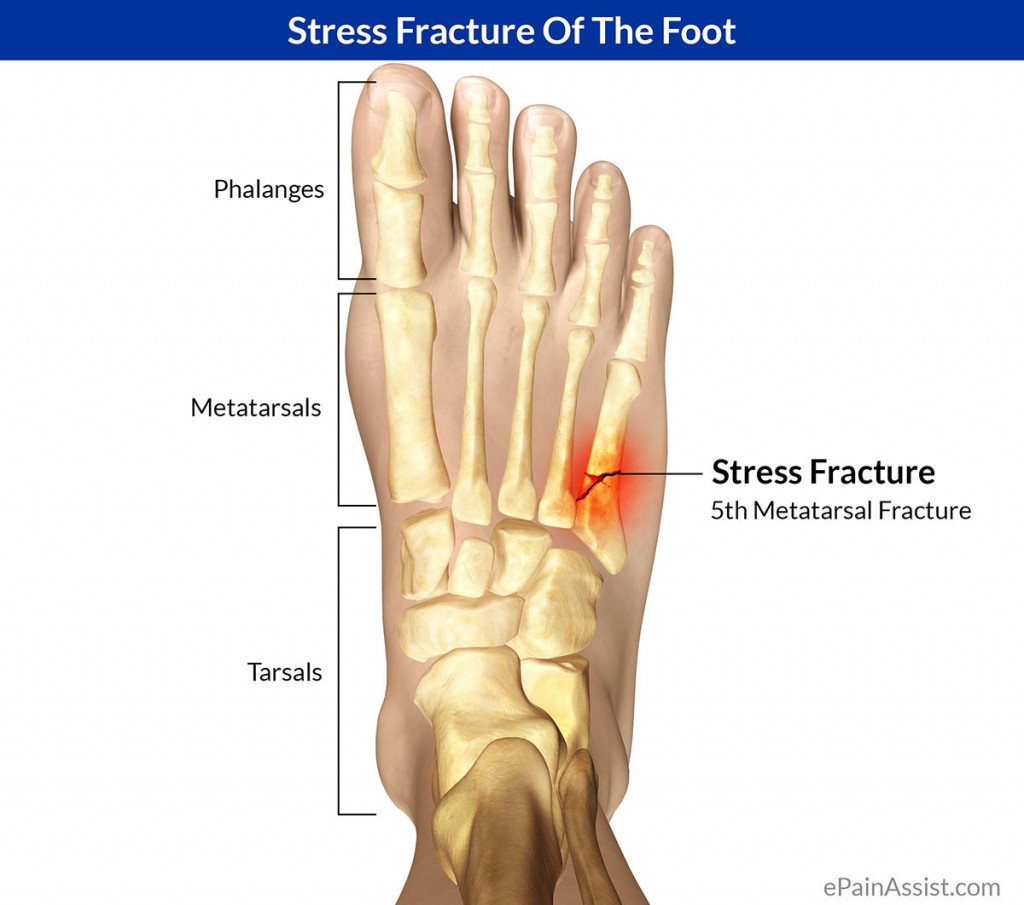 How Do You Know If You Have A Bone Stress Facture Sports Physio Gold 