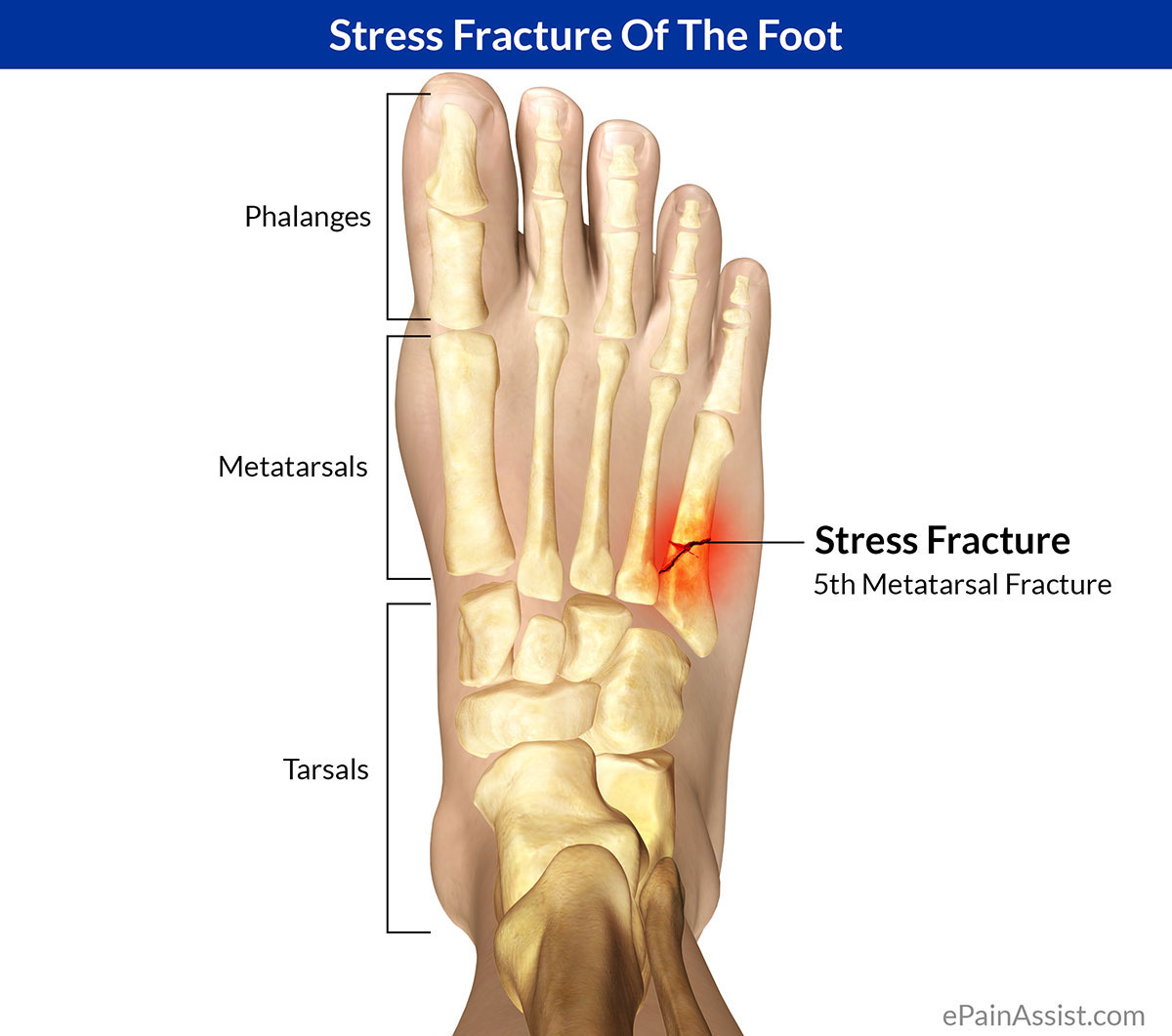 How Do You Know If You Have A Bone Stress Facture Sports Physio Gold 