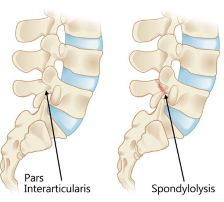 stress fracture back | Sports Physio Massage Gold Coast | Ashmore ...